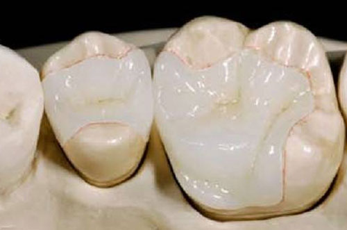 Inlays or Onlays