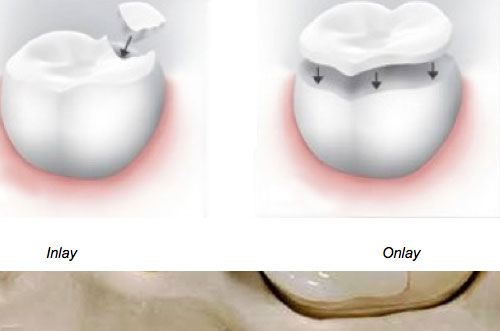 Inlays or Onlays 2