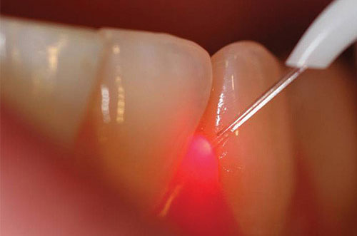 Gum Grafting treatment