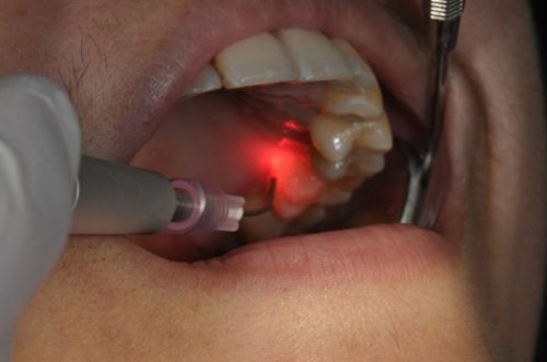 Laser Gum Treatment