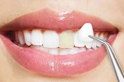Smile Restoration Porcelain Veneer