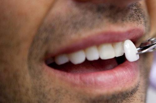 Porcelain Veneers for Men