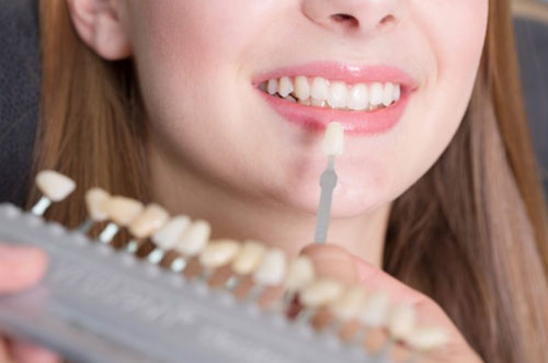 Porcelain Veneers