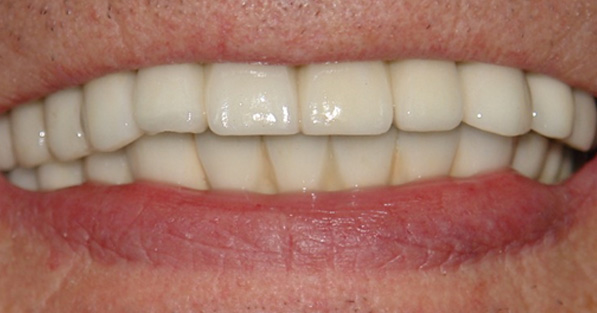 Full Mouth Rehabilitation 2