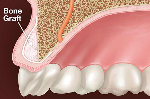 Bone Grafting