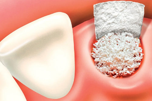 Bone grafting treatment