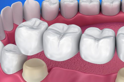 Dental Bridge Crown