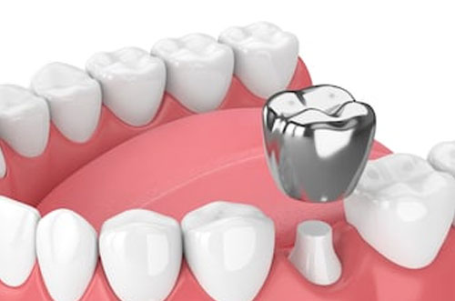 Single Tooth Zircon Crown