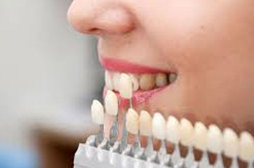 Single tooth crown using Porcelain Veneers