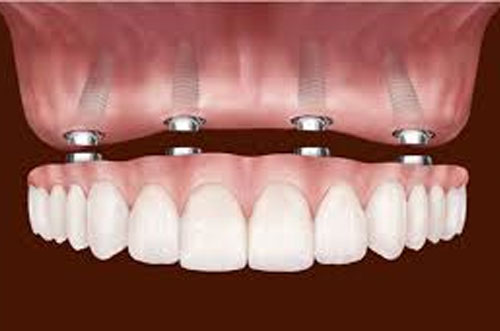 Dental Dentures