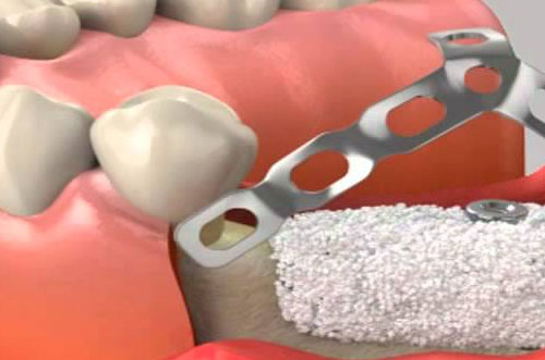 Guided Tissue Restoration
