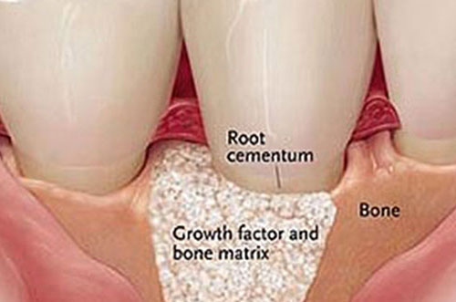 Guided Tissue Regeneration