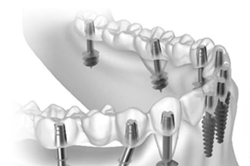 Basal Implant