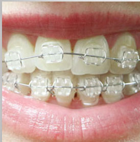 Ceramic Braces