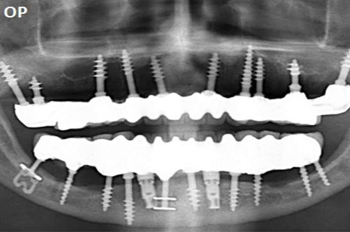 X-ray of dental implants