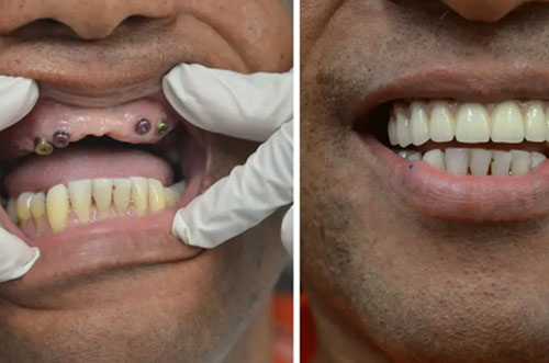 Full Mouth Dental Implants