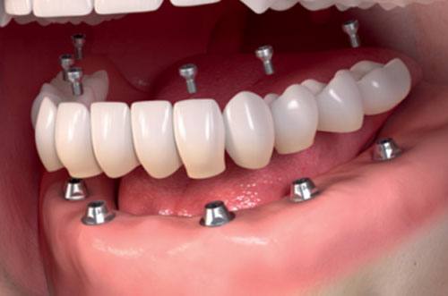 Full Mouth Dental Implants