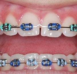 Metal Braces