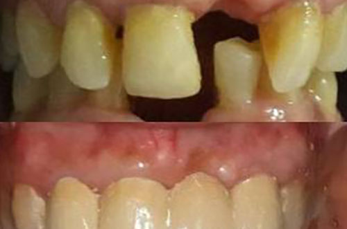 Periodontal Surgery