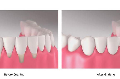 Receeding Gum Issue treatment