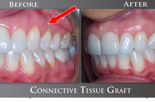 Receding Gum Ailment