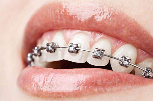 Self Ligating Braces
