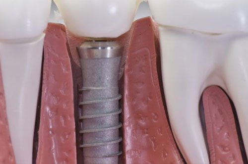 Single Tooth Dental Implant