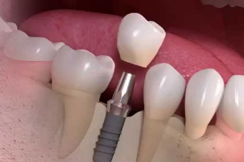Single Tooth Dental Implant