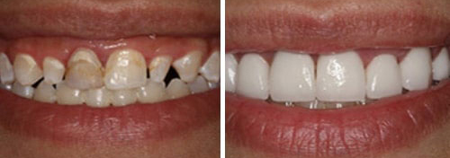 Smile Designing