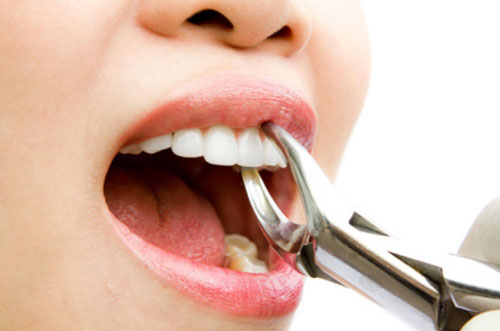 Tooth Extraction by an Orthodontist