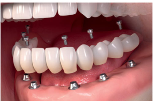 Tooth Extraction Diagram